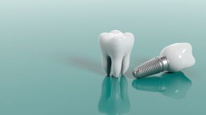 ] 5 coisas que você não sabia sobre implantes dentários
